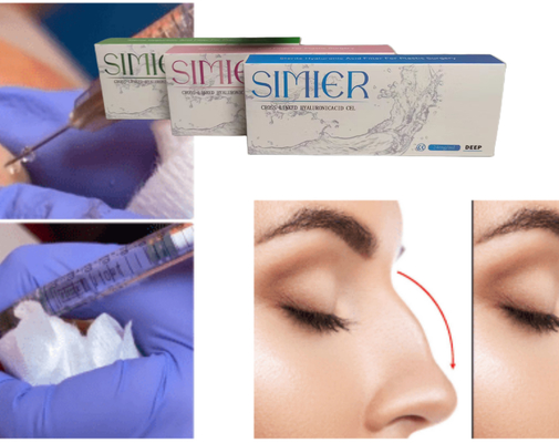 Trattamento per iniezione di gel di ialuronato di sodio trasparente da 10 ml per riempire le linee del sorriso