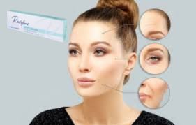 Acido ialuronico per riempimento cutaneo 1x1.1 ml Riempimento labiale
