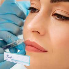 Acido ialuronico iniettabile filler cutaneo gel iniettabile per le labbra