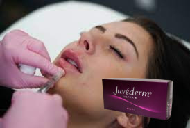 Acido ialuronico per la pelle femminile con collegamento incrociato Juvederm Lip Filler Ultra 3
