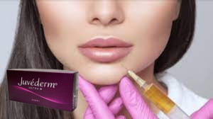 Juvederm Ultra 3 Acido Ialuronico HA Riempitore Dermico 2 ml Aumentatore delle labbra