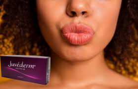 Juvederm Ultra 3 Acido Ialuronico HA Riempitore Dermico 2 ml Aumentatore delle labbra