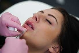 GMP Juvederm Ultra 3 HA Riempitore Dermico Per Labbra Juvederm Vollure